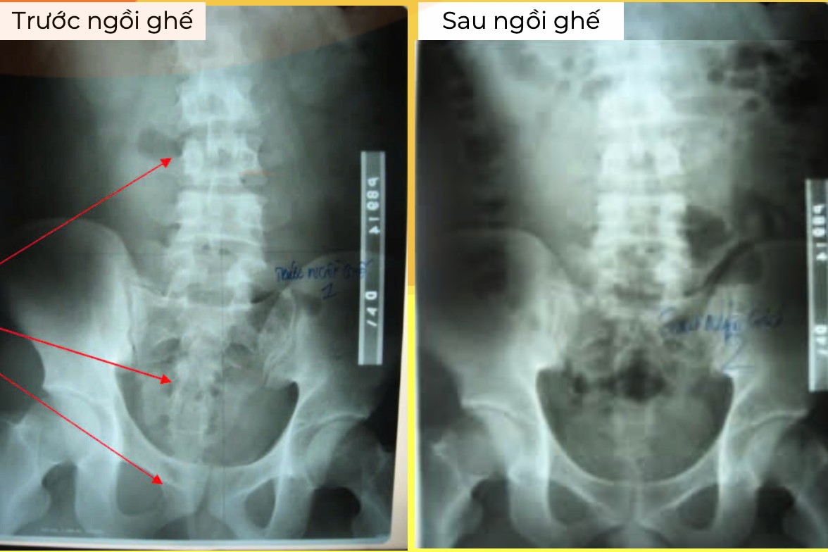 X-quang cột sống trước và sau khi ngồi ghế Doctorloan