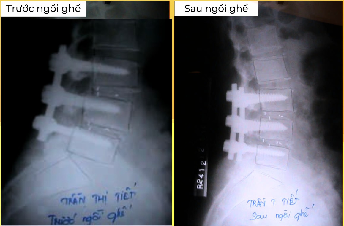 X-quang tình trạng trượt đốt sống trước và sau khi dùng ghế